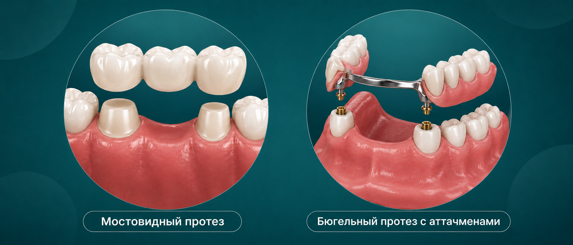 Варианты частичного протезирования зубов